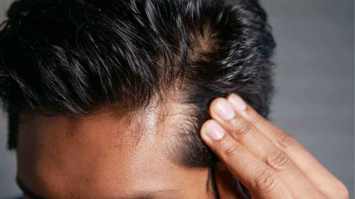 La caída del cabello en hombres: Por qué muchos buscan información sobre Minoxidil y alternativas naturales